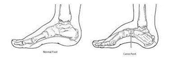 pes cavus foot